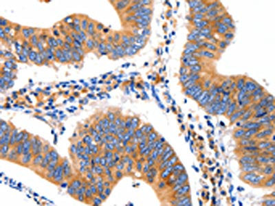 The image on the left is immunohistochemistry of paraffin-embedded Human colon cancer tissue using CSB-PA559950(GRM1 Antibody) at dilution 1/10, on the right is treated with synthetic peptide. (Original magnification: ×200)
