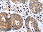 The image on the left is immunohistochemistry of paraffin-embedded Human colon cancer tissue using CSB-PA559966(PSPN Antibody) at dilution 1/25, on the right is treated with synthetic peptide. (Original magnification: ×200)