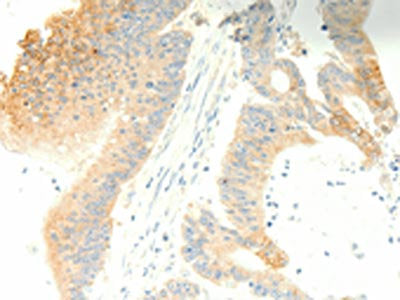 The image on the left is immunohistochemistry of paraffin-embedded Human colon cancer tissue using CSB-PA560159(PTGES3 Antibody) at dilution 1/35, on the right is treated with fusion protein. (Original magnification: ×200)