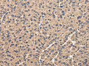 The image on the left is immunohistochemistry of paraffin-embedded Human liver cancer tissue using CSB-PA560189(UQCRC1 Antibody) at dilution 1/35, on the right is treated with fusion protein. (Original magnification: ×200)