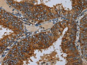 The image on the left is immunohistochemistry of paraffin-embedded Human colon cancer tissue using CSB-PA560273(MIER2 Antibody) at dilution 1/50, on the right is treated with fusion protein. (Original magnification: ×200)