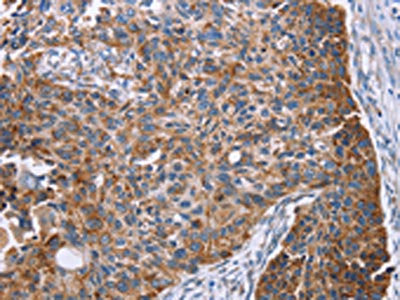 The image on the left is immunohistochemistry of paraffin-embedded Human esophagus cancer tissue using CSB-PA560275(PMPCB Antibody) at dilution 1/25, on the right is treated with fusion protein. (Original magnification: ×200)