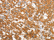 The image on the left is immunohistochemistry of paraffin-embedded Human thyroid cancer tissue using CSB-PA560286(WNT3A Antibody) at dilution 1/40, on the right is treated with fusion protein. (Original magnification: ×200)