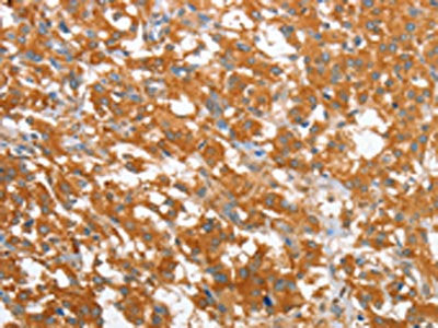 The image on the left is immunohistochemistry of paraffin-embedded Human thyroid cancer tissue using CSB-PA560286(WNT3A Antibody) at dilution 1/40, on the right is treated with fusion protein. (Original magnification: ×200)