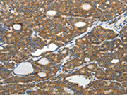 The image on the left is immunohistochemistry of paraffin-embedded Human thyroid cancer tissue using CSB-PA560340(SLC12A4 Antibody) at dilution 1/30, on the right is treated with fusion protein. (Original magnification: ×200)