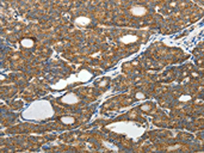 The image on the left is immunohistochemistry of paraffin-embedded Human thyroid cancer tissue using CSB-PA560340(SLC12A4 Antibody) at dilution 1/30, on the right is treated with fusion protein. (Original magnification: ×200)