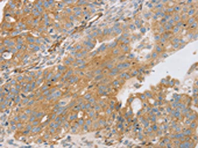 The image on the left is immunohistochemistry of paraffin-embedded Human breast cancer tissue using CSB-PA560536(STX16 Antibody) at dilution 1/30, on the right is treated with fusion protein. (Original magnification: ×200)