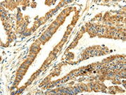 The image on the left is immunohistochemistry of paraffin-embedded Human esophagus cancer tissue using CSB-PA560918(UBL4B Antibody) at dilution 1/25, on the right is treated with fusion protein. (Original magnification: ×200)