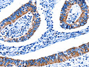 The image on the left is immunohistochemistry of paraffin-embedded Human colon cancer tissue using CSB-PA560952(CTSH Antibody) at dilution 1/5, on the right is treated with fusion protein. (Original magnification: ×200)