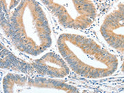 The image on the left is immunohistochemistry of paraffin-embedded Human colon cancer tissue using CSB-PA560972(CKAP2 Antibody) at dilution 1/50, on the right is treated with fusion protein. (Original magnification: ×200)