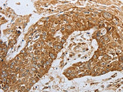 The image on the left is immunohistochemistry of paraffin-embedded Human esophagus cancer tissue using CSB-PA561050(CKM Antibody) at dilution 1/50, on the right is treated with synthetic peptide. (Original magnification: ×200)