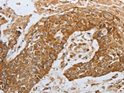 The image on the left is immunohistochemistry of paraffin-embedded Human esophagus cancer tissue using CSB-PA561050(CKM Antibody) at dilution 1/50, on the right is treated with synthetic peptide. (Original magnification: ×200)