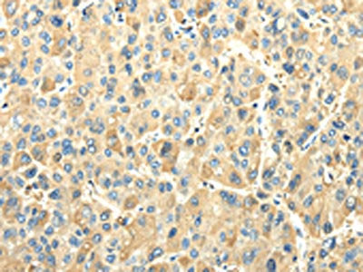 The image on the left is immunohistochemistry of paraffin-embedded Human liver cancer tissue using CSB-PA561188(EFNA3 Antibody) at dilution 1/25, on the right is treated with fusion protein. (Original magnification: ×200)