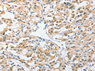 The image on the left is immunohistochemistry of paraffin-embedded Human thyroid cancer tissue using CSB-PA561195(UCHL5 Antibody) at dilution 1/25, on the right is treated with fusion protein. (Original magnification: ×200)