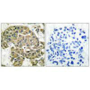 Immunohistochemical analysis of paraffin-embedded human breast carcinoma tissue using Mammaglobin B antibody.