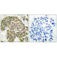 Immunohistochemical analysis of paraffin-embedded human breast carcinoma tissue using Mammaglobin B antibody.