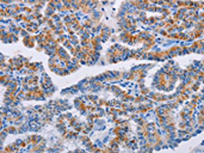 The image on the left is immunohistochemistry of paraffin-embedded Human thyroid cancer tissue using CSB-PA561279(BCL2A1 Antibody) at dilution 1/20, on the right is treated with fusion protein. (Original magnification: ×200)