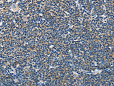 The image on the left is immunohistochemistry of paraffin-embedded Human lymphoma tissue using CSB-PA561551(NEK5 Antibody) at dilution 1/60, on the right is treated with synthetic peptide. (Original magnification: ×200)