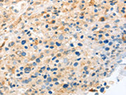 The image on the left is immunohistochemistry of paraffin-embedded Human ovarian cancer tissue using CSB-PA561582(LYVE1 Antibody) at dilution 1/20, on the right is treated with fusion protein. (Original magnification: ×200)