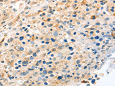 The image on the left is immunohistochemistry of paraffin-embedded Human ovarian cancer tissue using CSB-PA561582(LYVE1 Antibody) at dilution 1/20, on the right is treated with fusion protein. (Original magnification: ×200)
