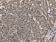 The image on the left is immunohistochemistry of paraffin-embedded Human cervical cancer tissue using CSB-PA561781(DCTN4 Antibody) at dilution 1/30, on the right is treated with fusion protein. (Original magnification: ×200)