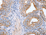 The image on the left is immunohistochemistry of paraffin-embedded Human cervical cancer tissue using CSB-PA561954(CLDN3 Antibody) at dilution 1/25, on the right is treated with synthetic peptide. (Original magnification: ×200)