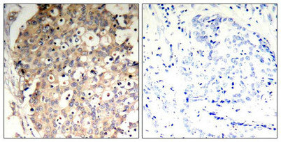 Immunohistochemical analysis of paraffin-embedded human breast carcinoma tissue using SHP-1(Phospho-Tyr536) Antibody(left) or the same antibody preincubated with blocking peptide(right).