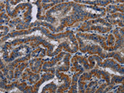 The image on the left is immunohistochemistry of paraffin-embedded Human thyroid cancer tissue using CSB-PA562259(KLK11 Antibody) at dilution 1/40, on the right is treated with fusion protein. (Original magnification: ×200)