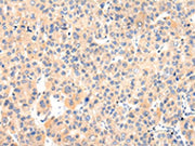 The image on the left is immunohistochemistry of paraffin-embedded Human liver cancer tissue using CSB-PA562311(VASH1 Antibody) at dilution 1/25, on the right is treated with fusion protein. (Original magnification: ×200)