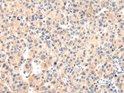 The image on the left is immunohistochemistry of paraffin-embedded Human liver cancer tissue using CSB-PA562311(VASH1 Antibody) at dilution 1/25, on the right is treated with fusion protein. (Original magnification: ×200)