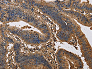 The image on the left is immunohistochemistry of paraffin-embedded Human colon cancer tissue using CSB-PA562372(KCNG1 Antibody) at dilution 1/40, on the right is treated with synthetic peptide. (Original magnification: ×200)