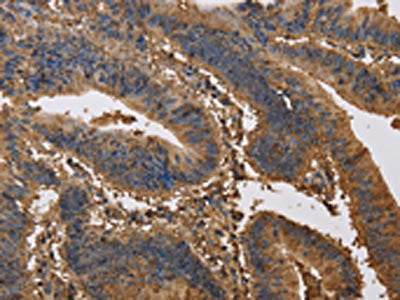 The image on the left is immunohistochemistry of paraffin-embedded Human colon cancer tissue using CSB-PA562372(KCNG1 Antibody) at dilution 1/40, on the right is treated with synthetic peptide. (Original magnification: ×200)