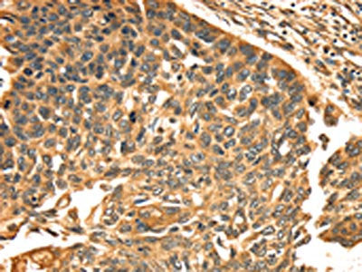 The image on the left is immunohistochemistry of paraffin-embedded Human esophagus cancer tissue using CSB-PA562393(TGM1 Antibody) at dilution 1/30, on the right is treated with synthetic peptide. (Original magnification: ×200)