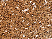 The image on the left is immunohistochemistry of paraffin-embedded Human breast cancer tissue using CSB-PA562564(ANKRD1 Antibody) at dilution 1/20, on the right is treated with fusion protein. (Original magnification: ×200)