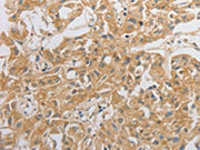 The image on the left is immunohistochemistry of paraffin-embedded Human lung cancer tissue using CSB-PA562577(HCRTR2 Antibody) at dilution 1/50, on the right is treated with synthetic peptide. (Original magnification: ×200)