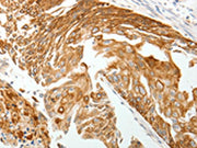 The image on the left is immunohistochemistry of paraffin-embedded Human cervical cancer tissue using CSB-PA562700(TMSB10 Antibody) at dilution 1/15, on the right is treated with synthetic peptide. (Original magnification: ×200)