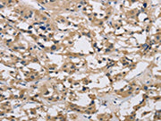The image on the left is immunohistochemistry of paraffin-embedded Human thyroid cancer tissue using CSB-PA562817(IMPDH1 Antibody) at dilution 1/20, on the right is treated with synthetic peptide. (Original magnification: ×200)