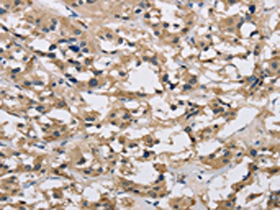 The image on the left is immunohistochemistry of paraffin-embedded Human thyroid cancer tissue using CSB-PA562817(IMPDH1 Antibody) at dilution 1/20, on the right is treated with synthetic peptide. (Original magnification: ×200)