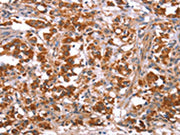 The image on the left is immunohistochemistry of paraffin-embedded Human thyroid cancer tissue using CSB-PA562827(GLMN Antibody) at dilution 1/40, on the right is treated with synthetic peptide. (Original magnification: ×200)