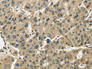 The image on the left is immunohistochemistry of paraffin-embedded Human liver cancer tissue using CSB-PA562987(TSSC1 Antibody) at dilution 1/25, on the right is treated with fusion protein. (Original magnification: ×200)