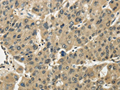 The image on the left is immunohistochemistry of paraffin-embedded Human liver cancer tissue using CSB-PA562987(TSSC1 Antibody) at dilution 1/25, on the right is treated with fusion protein. (Original magnification: ×200)