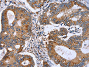 The image on the left is immunohistochemistry of paraffin-embedded Human colon cancer tissue using CSB-PA563134(MMP9 Antibody) at dilution 1/30, on the right is treated with synthetic peptide. (Original magnification: ×200)
