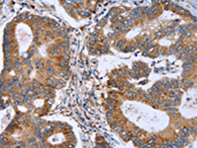 The image on the left is immunohistochemistry of paraffin-embedded Human colon cancer tissue using CSB-PA563134(MMP9 Antibody) at dilution 1/30, on the right is treated with synthetic peptide. (Original magnification: ×200)