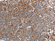The image on the left is immunohistochemistry of paraffin-embedded Human ovarian cancer tissue using CSB-PA563141(PLXNA2 Antibody) at dilution 1/40, on the right is treated with synthetic peptide. (Original magnification: ×200)