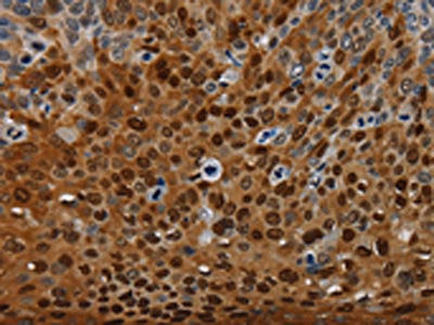 The image on the left is immunohistochemistry of paraffin-embedded Human cervical cancer tissue using CSB-PA563181(NRP2 Antibody) at dilution 1/35, on the right is treated with synthetic peptide. (Original magnification: ×200)