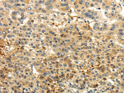 The image on the left is immunohistochemistry of paraffin-embedded Human liver cancer tissue using CSB-PA563243(CAMK1G Antibody) at dilution 1/30, on the right is treated with fusion protein. (Original magnification: ×200)