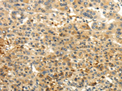 The image on the left is immunohistochemistry of paraffin-embedded Human liver cancer tissue using CSB-PA563243(CAMK1G Antibody) at dilution 1/30, on the right is treated with fusion protein. (Original magnification: ×200)