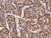 The image on the left is immunohistochemistry of paraffin-embedded Human liver cancer tissue using CSB-PA563307(GCG Antibody) at dilution 1/15, on the right is treated with synthetic peptide. (Original magnification: ×200)
