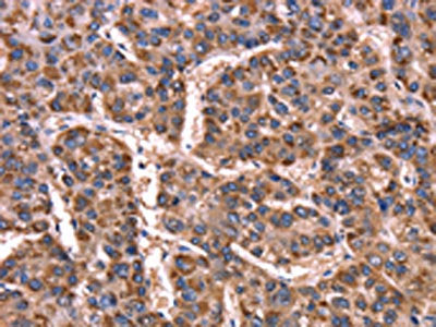 The image on the left is immunohistochemistry of paraffin-embedded Human liver cancer tissue using CSB-PA563307(GCG Antibody) at dilution 1/15, on the right is treated with synthetic peptide. (Original magnification: ×200)