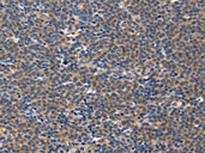 The image on the left is immunohistochemistry of paraffin-embedded Human Lymphoma tissue using CSB-PA563352(CD5L Antibody) at dilution 1/40, on the right is treated with synthetic peptide. (Original magnification: ×200)